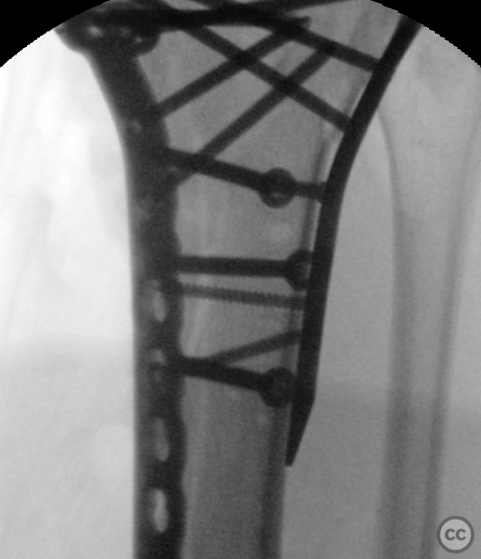 Schatzker Tibial Plateau With Lateral Femoral Epicondyle Osteotomy